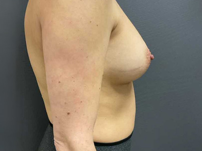 After: Borstvergroting