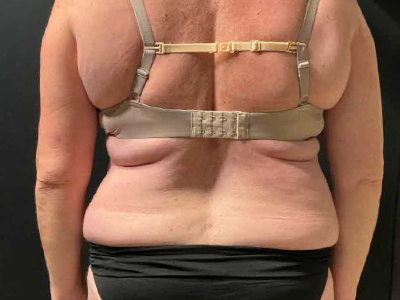 Before: Buikwandcorrectie