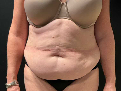 Before: Buikwandcorrectie