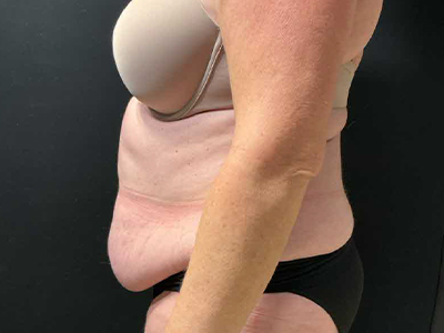 Before: Buikwandcorrectie
