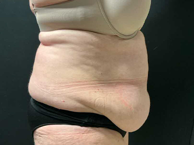Before: Buikwandcorrectie