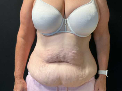 Before: Buikwandcorrectie