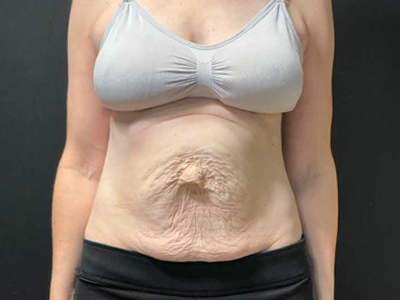 Before: Buikwandcorrectie