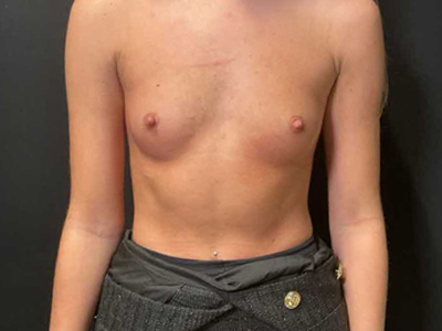 Before: Borstvergroting
