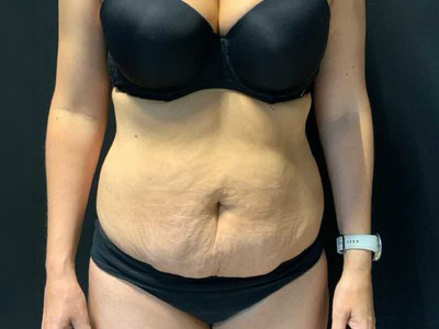 Before: Buikwandcorrectie
