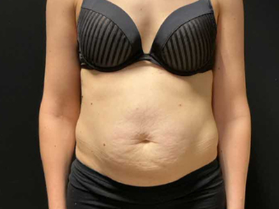 Before: Buikwandcorrectie