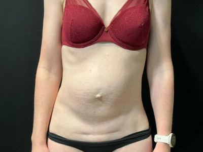 Before: Rectus Diastase