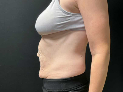 Before: Buikwandcorrectie