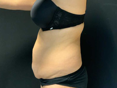 Before: Buikwandcorrectie