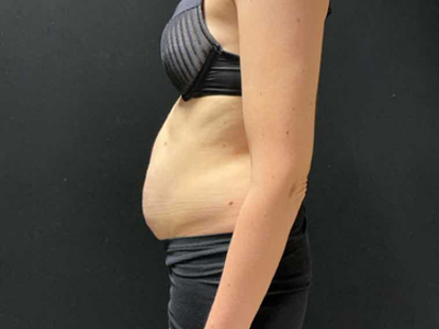 Before: Buikwandcorrectie