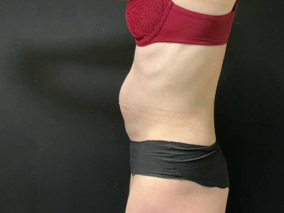Before: Rectus Diastase