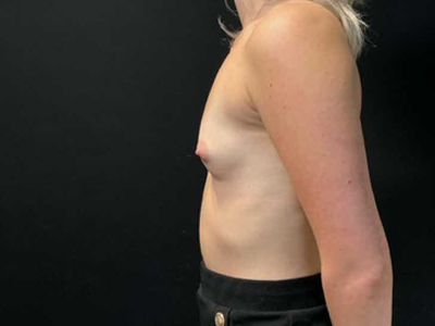 Before: Borstvergroting