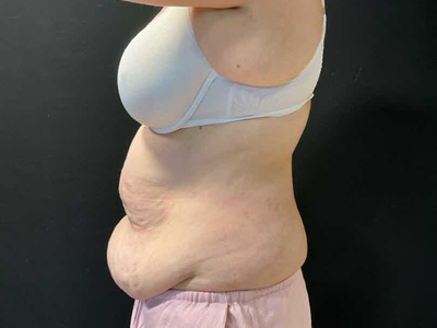 Before: Buikwandcorrectie