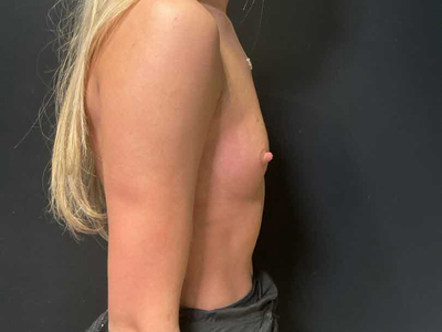 Before: Borstvergroting