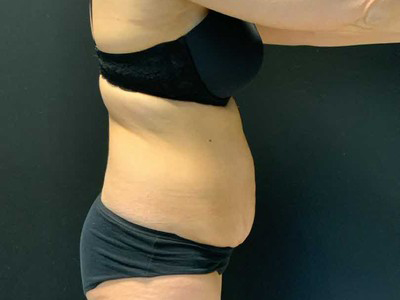 Before: Buikwandcorrectie