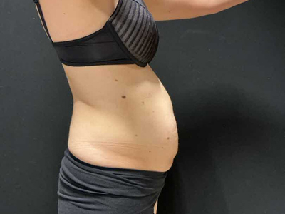 Before: Buikwandcorrectie