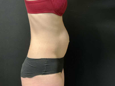 Before: Rectus Diastase