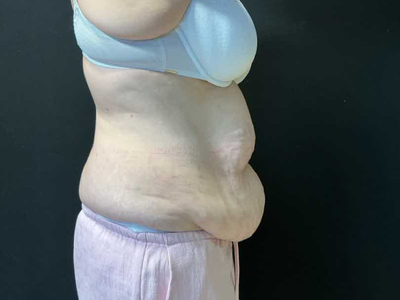 Before: Buikwandcorrectie